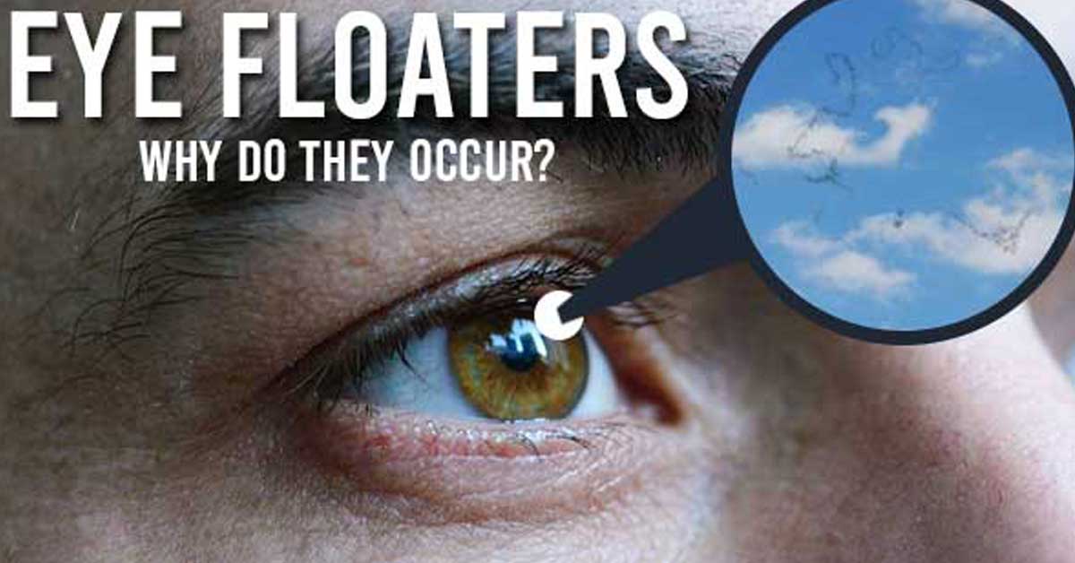 Eye Floaters Why Do They Occur? Williams Integracare Clinic