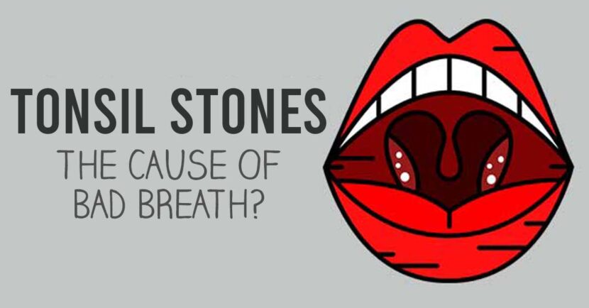 tonsil stones