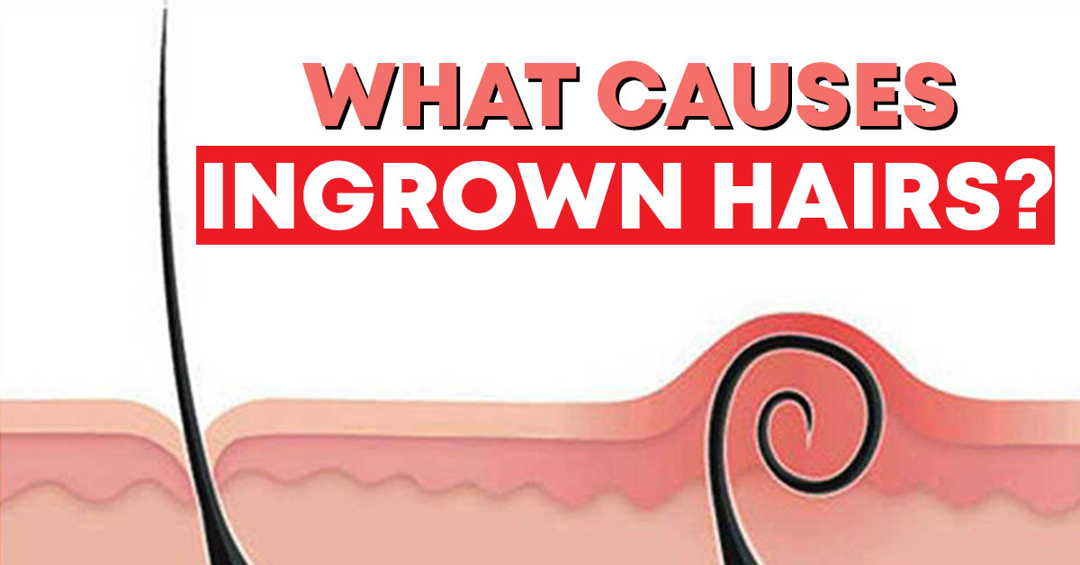 what causes ingrown hairs