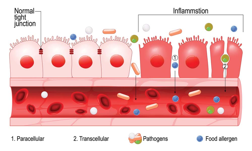 leaky gut diagram