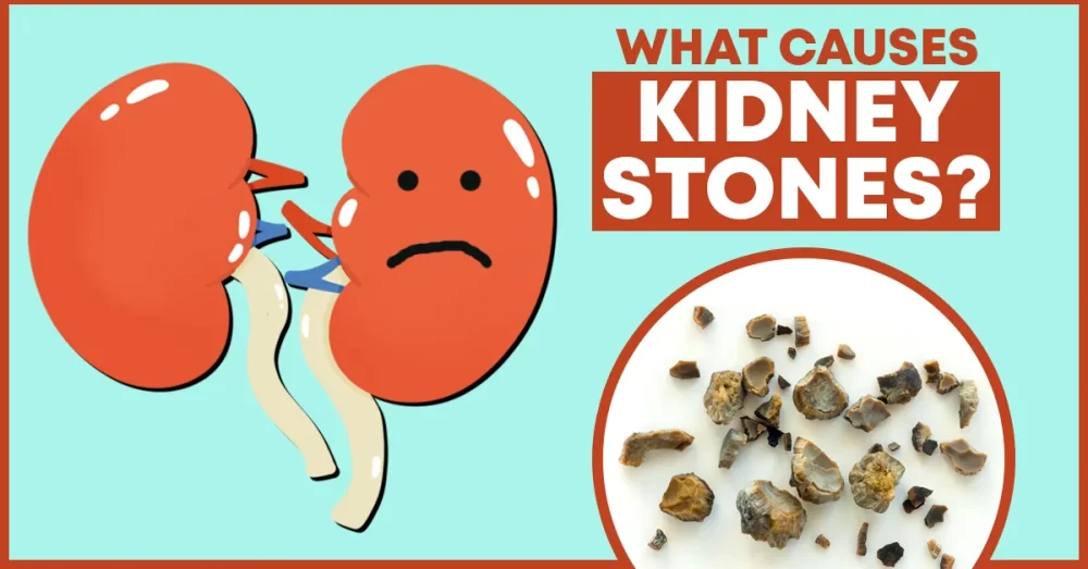 what causes kidney stones