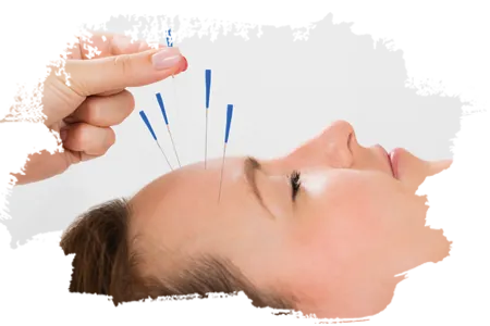 acupuncture at integracare