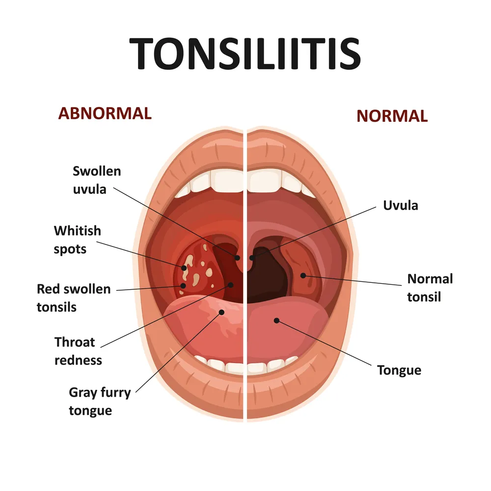 Tonsil Stones The Hidden Source Of Your Bad Breath Williams 
